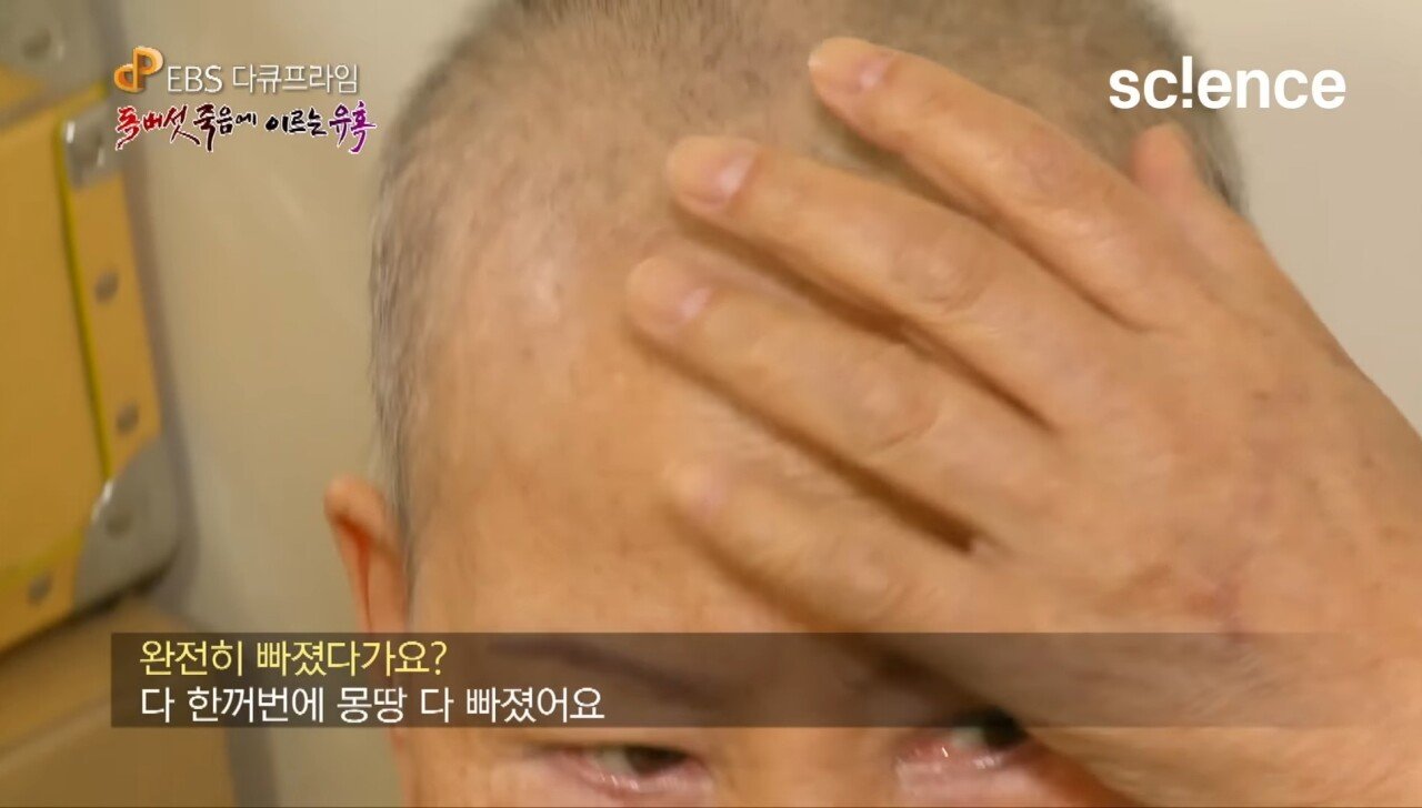 Screenshot_20231017_222621_YouTube.jpg 독버섯을 먹고 머리카락이 다 빠져버린 노부부.jpg