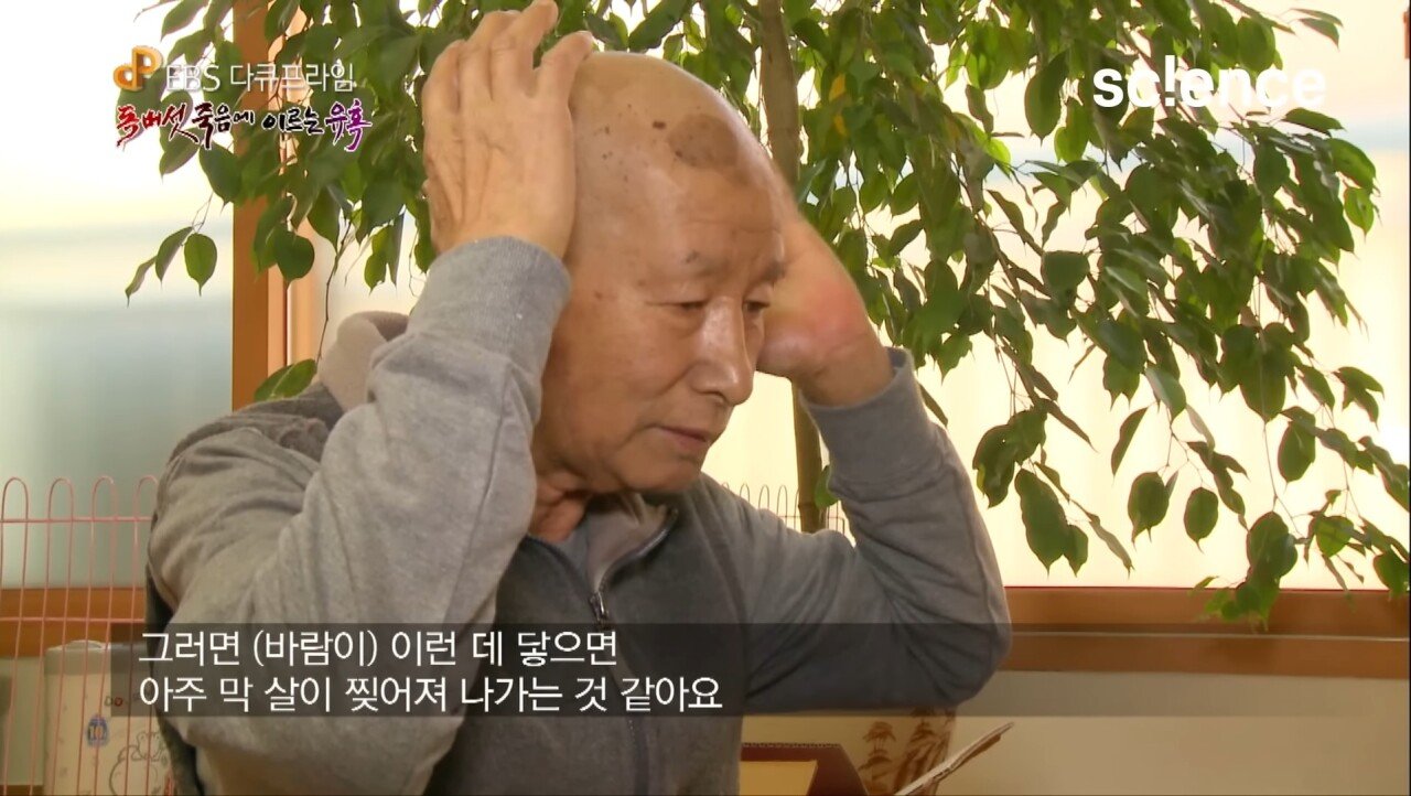 Screenshot_20231017_222628_YouTube.jpg 독버섯을 먹고 머리카락이 다 빠져버린 노부부.jpg