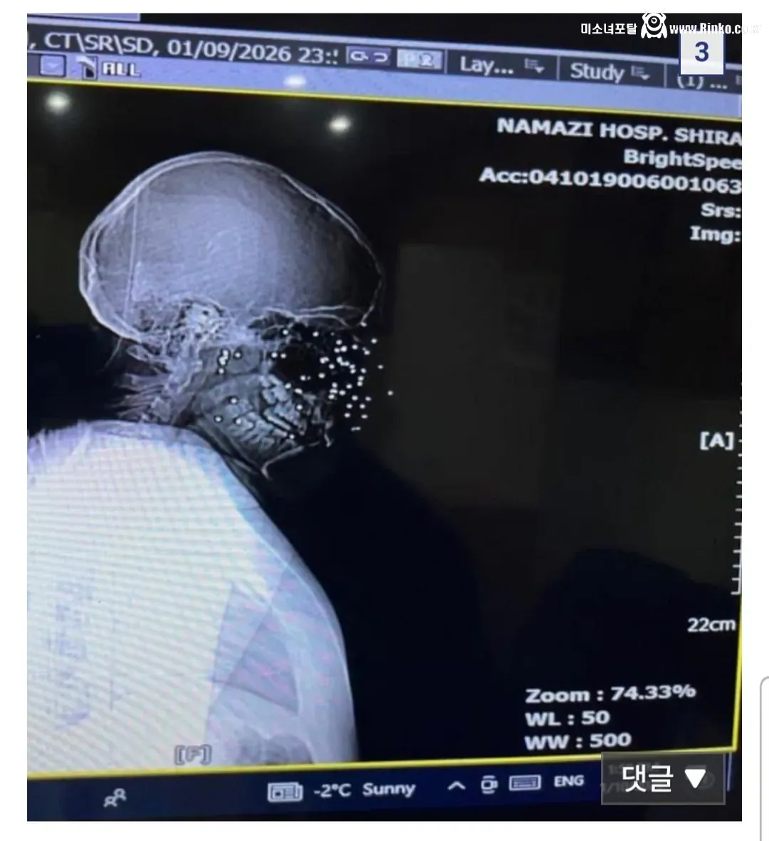 산탄총을 맞은 이란 시위대 여성의 엑스레이 사진 공개