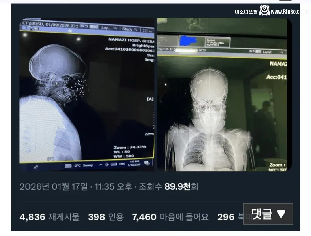 산탄총을 맞은 이란 시위대 여성의 엑스레이 사진 공개