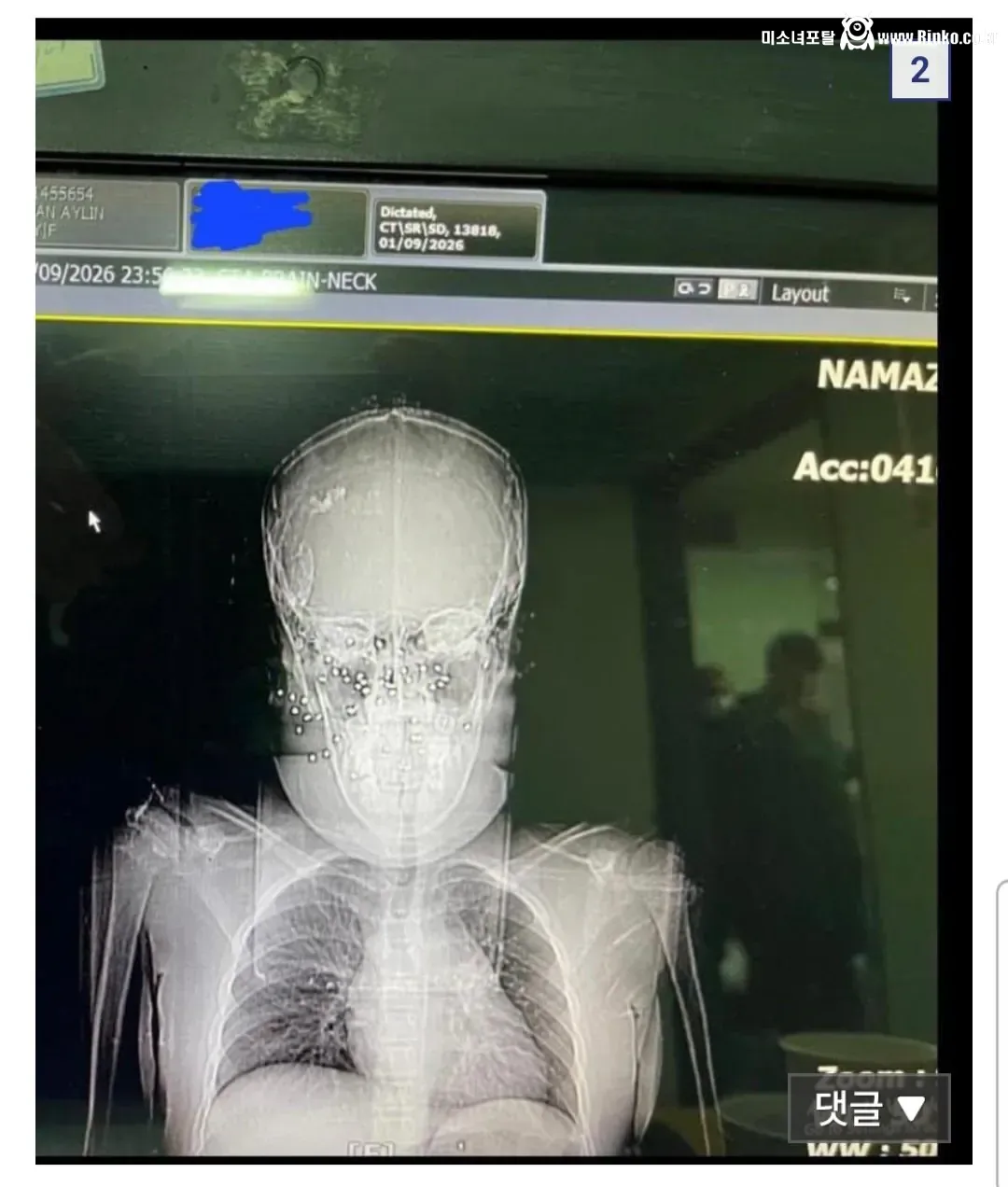 산탄총을 맞은 이란 시위대 여성의 엑스레이 사진 공개