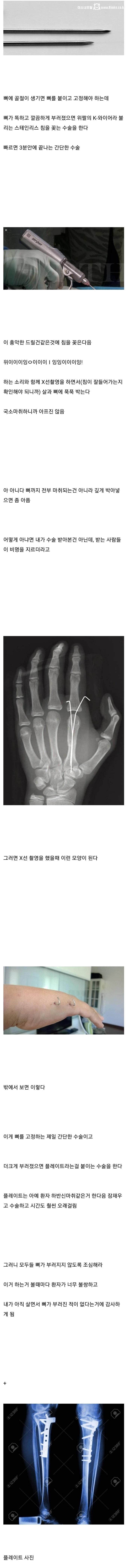 뼈 안 부러져본 사람들이 의외로 모르는 사실들
