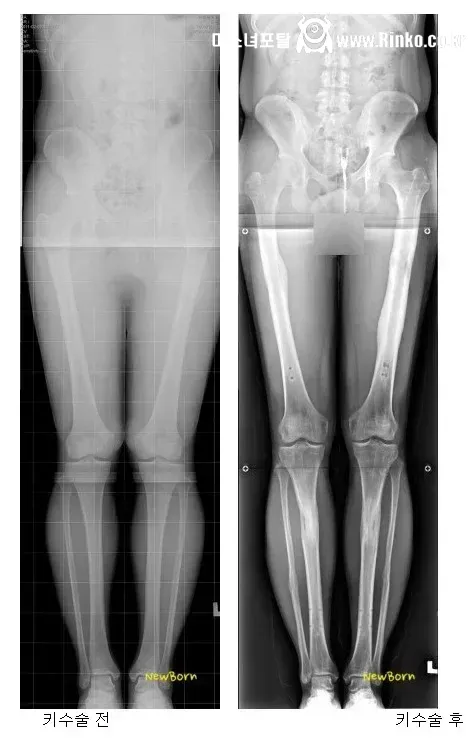 (약혐) 키 13cm 연장한 사람