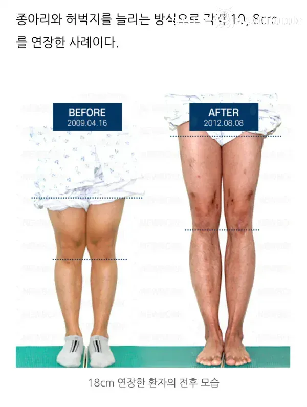 (약혐) 키 13cm 연장한 사람