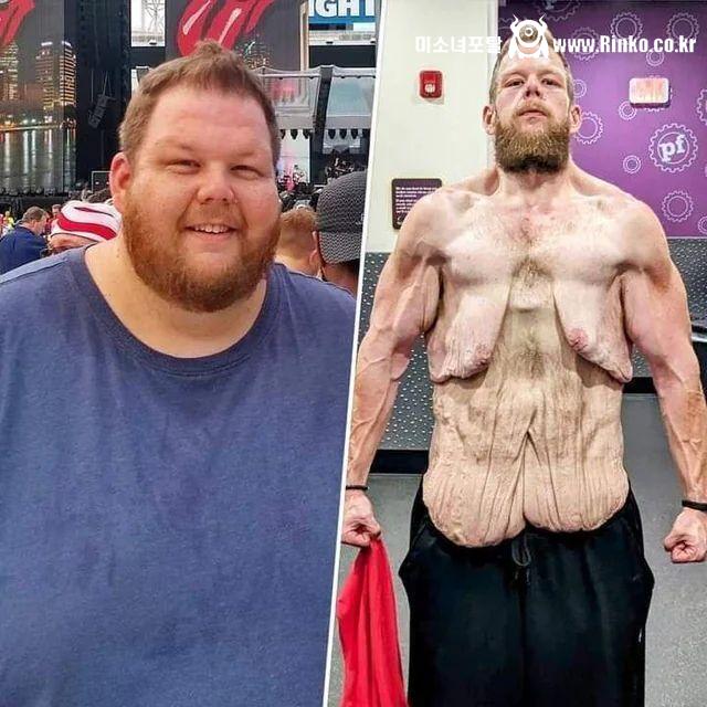 혐주의) 160kg 감량한 사람의 피부 상태