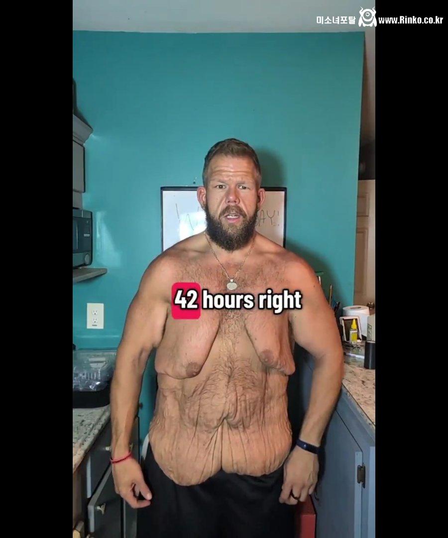 혐주의) 160kg 감량한 사람의 피부 상태