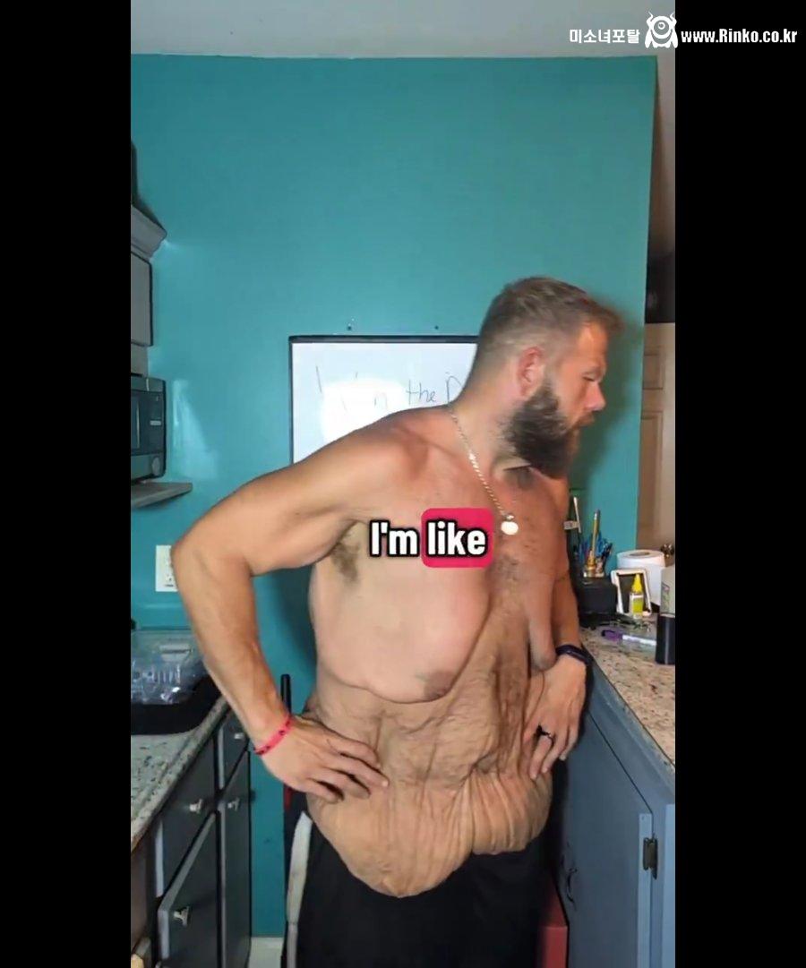 혐주의) 160kg 감량한 사람의 피부 상태