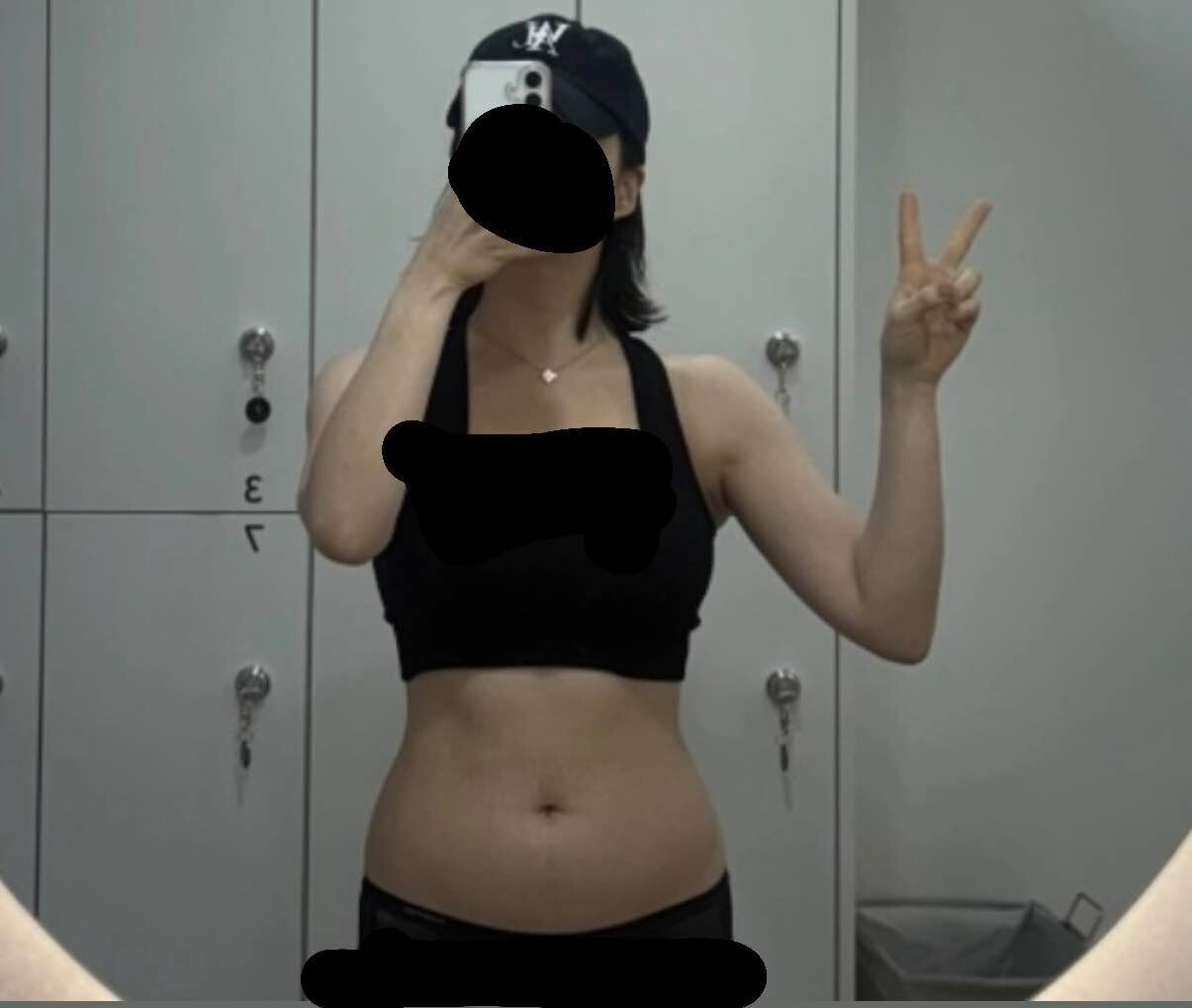 400만원 사용한 복부 지방흡입 전후 비교