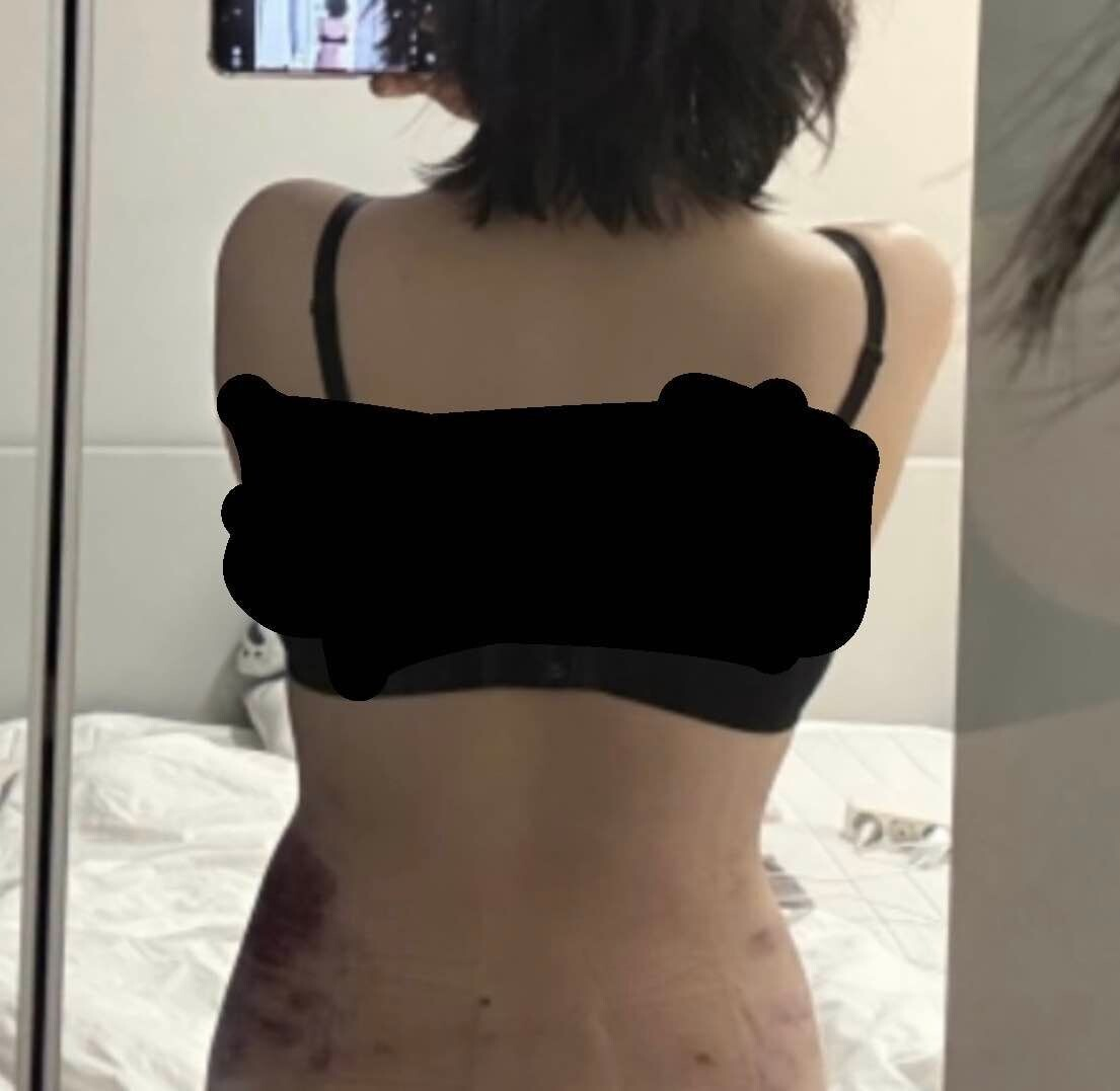 400만원 사용한 복부 지방흡입 전후 비교